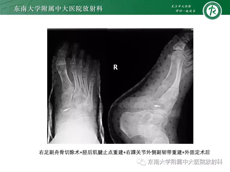 好文分享-《肌骨系统疾病——副舟骨综合征》
