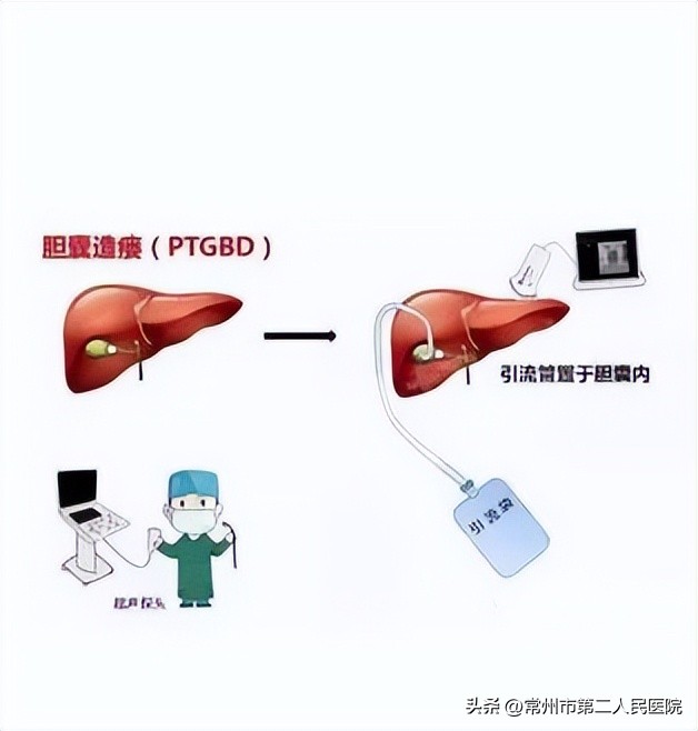 小针孔，用途多，漫画带你了解介入超声能做啥？