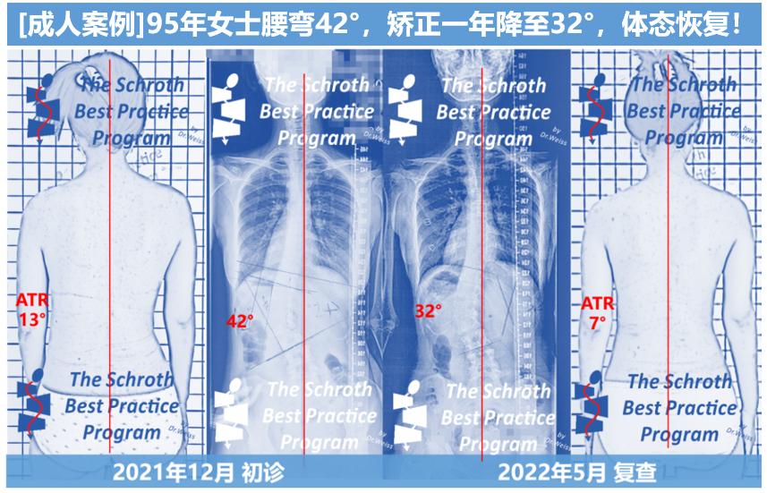 成人脊柱侧弯往哪弯,成年人脊柱侧弯怎么矫正