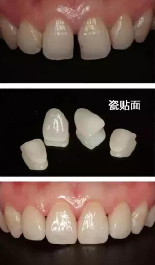 烤瓷牙牙龈发黑的明星,娱乐圈真的都是烤瓷牙吗