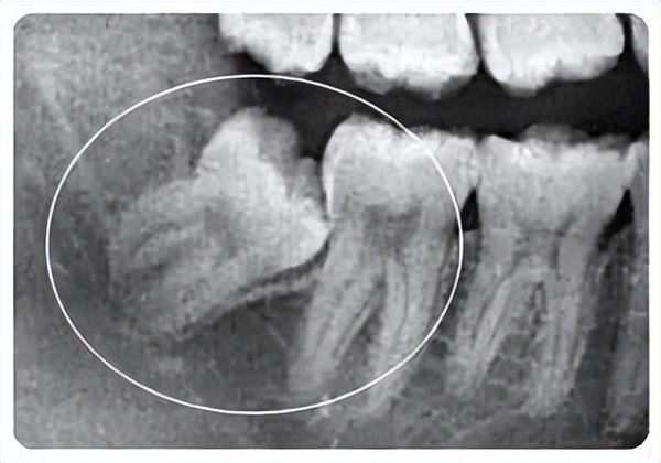 牙齿长小牙该怎么拔掉,牙齿长在上颌窦里了能拔吗