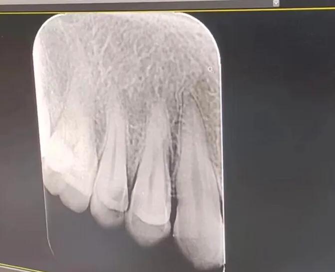 牙齿遇冷热刺激痛应该看什么科,牙齿冷热都疼要根管治疗吗