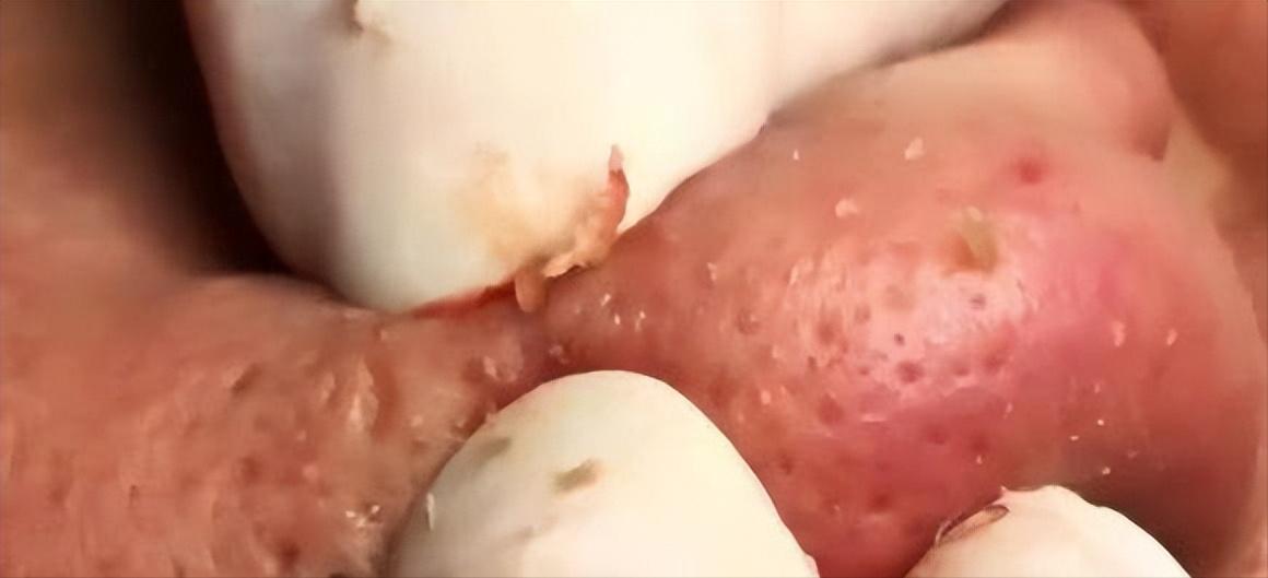 鼻子的黑头跟草莓一样,草莓黑头怎么去除最有效