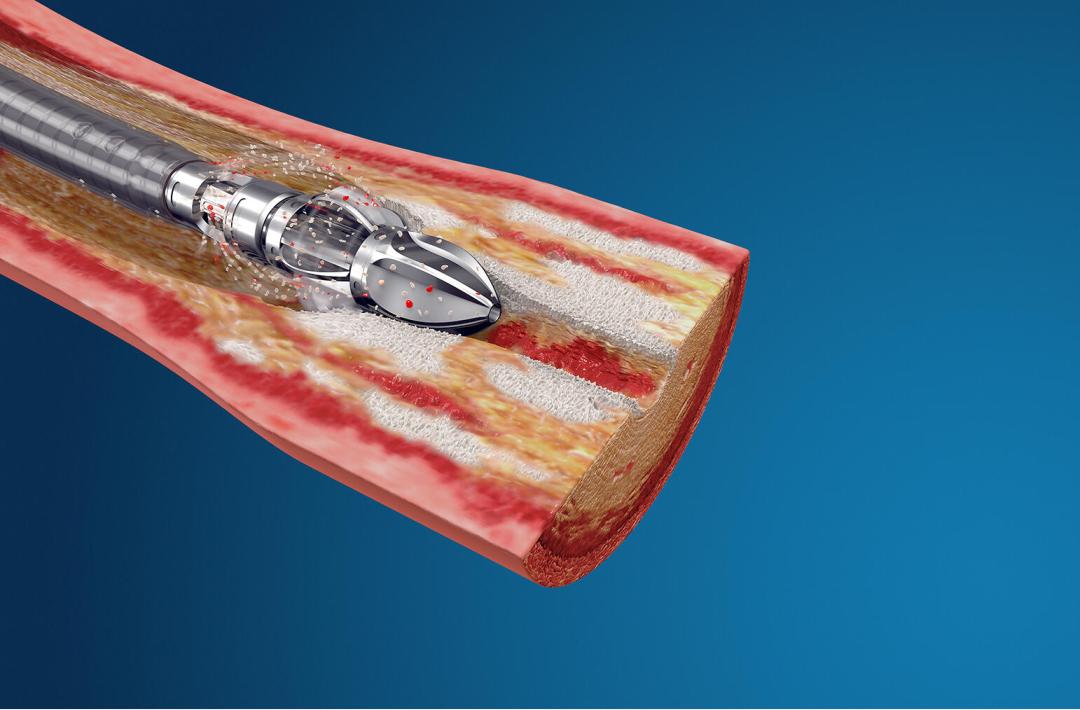 都有哪些医疗耗材已经带量采购,医疗器械最新采购政策