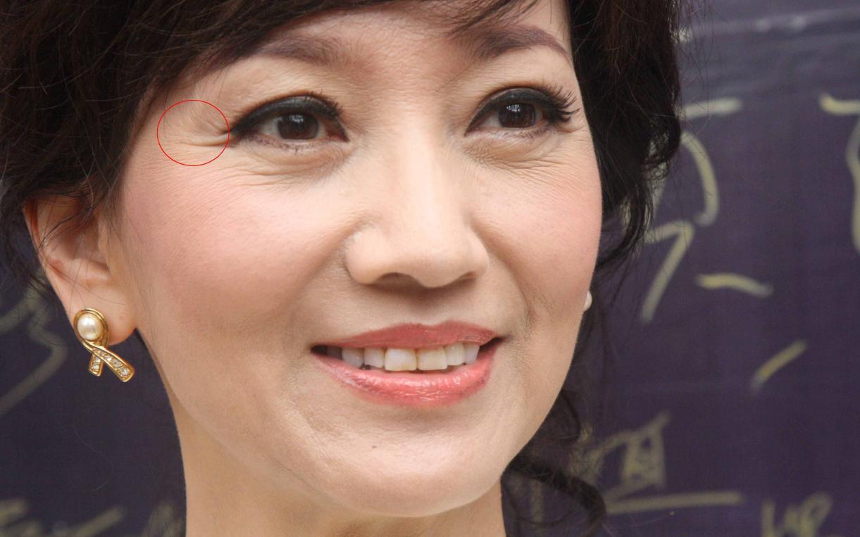 静态鱼尾纹和动态鱼尾纹怎么去除,什么是鱼尾纹法令纹抬头纹