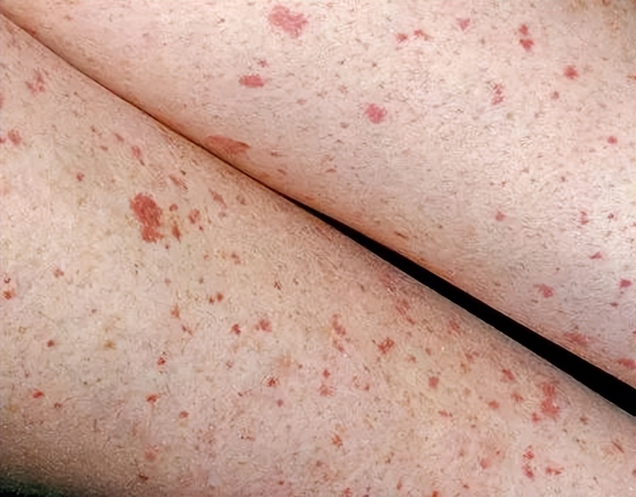 老公身上有吻痕可作为出轨证据吗,吻痕是出轨证据吗