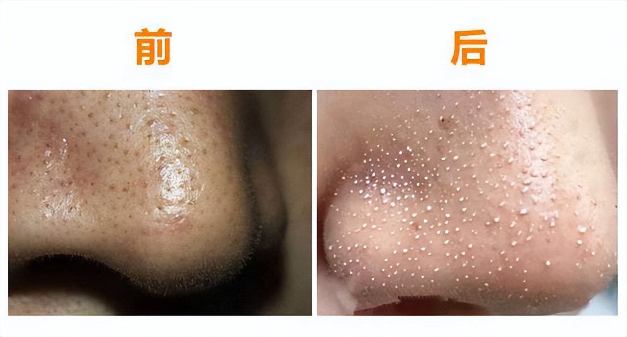 鼻头长黑粉刺怎么回事图片,鼻梁及两侧起了闭口粉刺