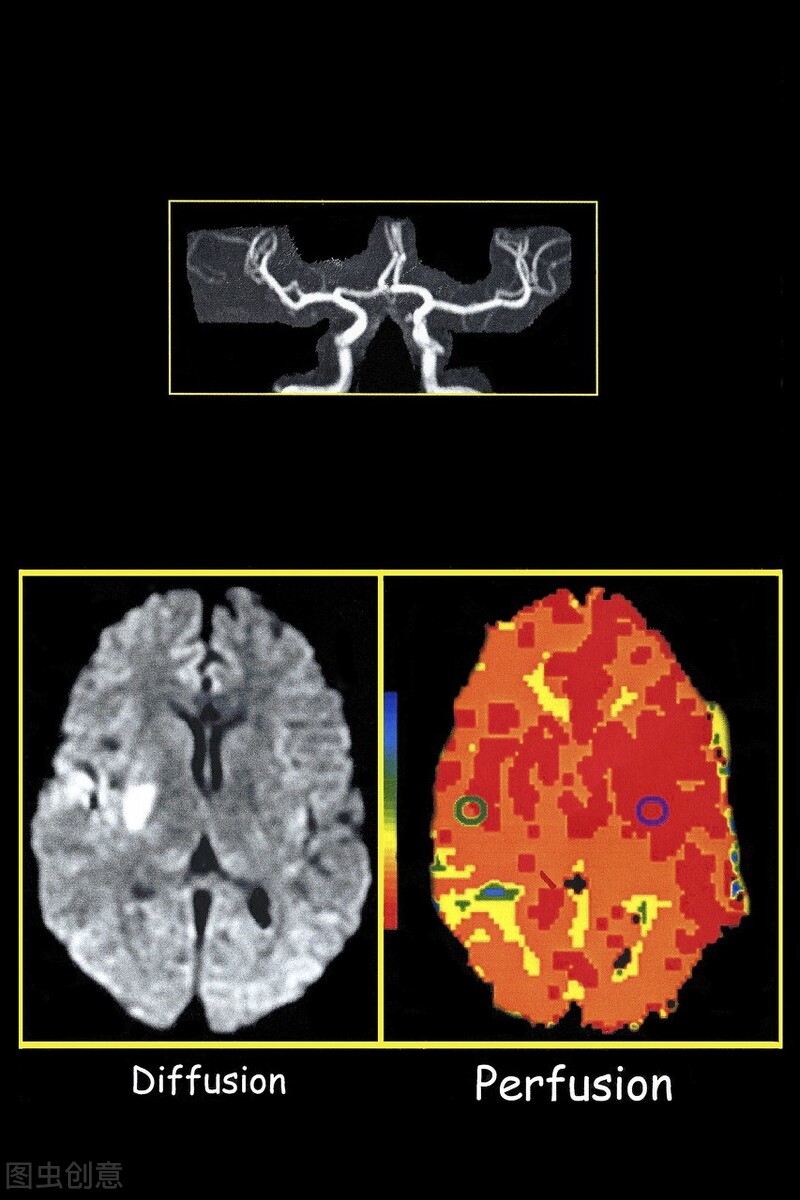 脑微出血灶属于什么伤,脑内微出血灶