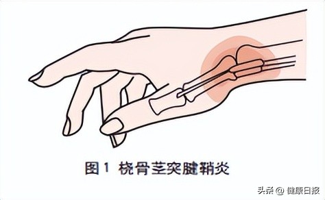 鼠标手和妈妈手都是腕管综合征吗,鼠标手和妈妈手