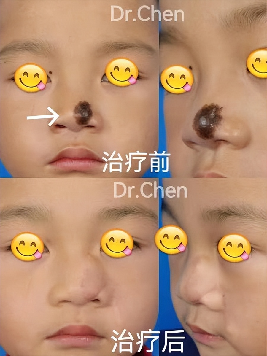 为什么有些痣医生说要祛二次,6mm的痣一定要切除吗