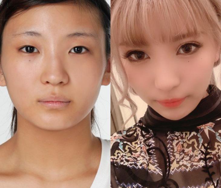 日本1米5小哥砸1600万疯狂整容增高！断骨惨烈过程吓傻网友