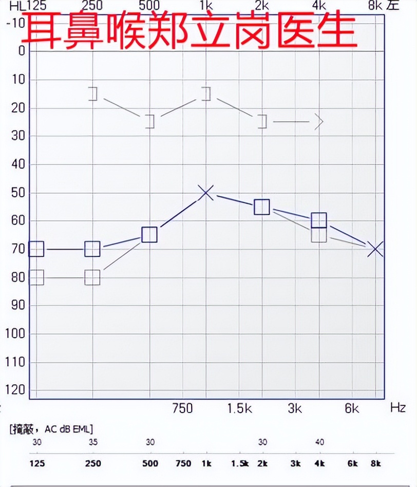 中耳炎手术失败案例,郑立岗中耳炎微创手术