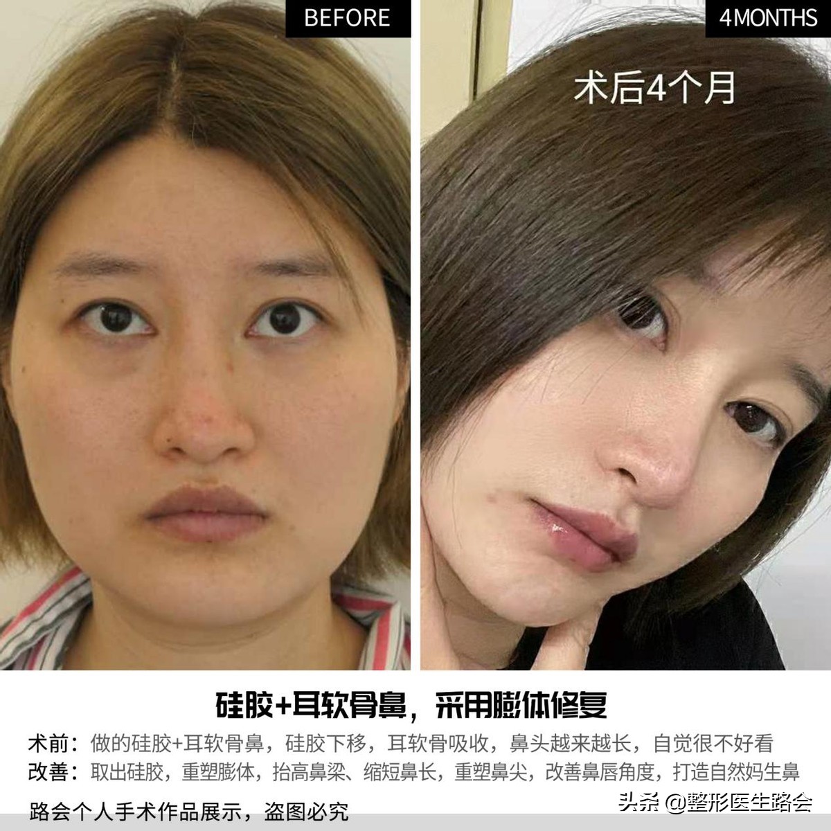 硅胶隆鼻和耳软骨隆鼻效果图,硅胶耳软骨隆鼻副作用