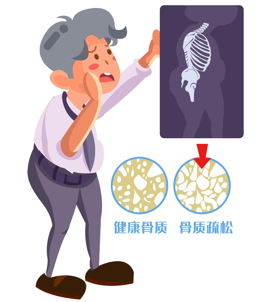 中老年骨折吃什么钙片补钙效果好,老年人骨折愈合全过程