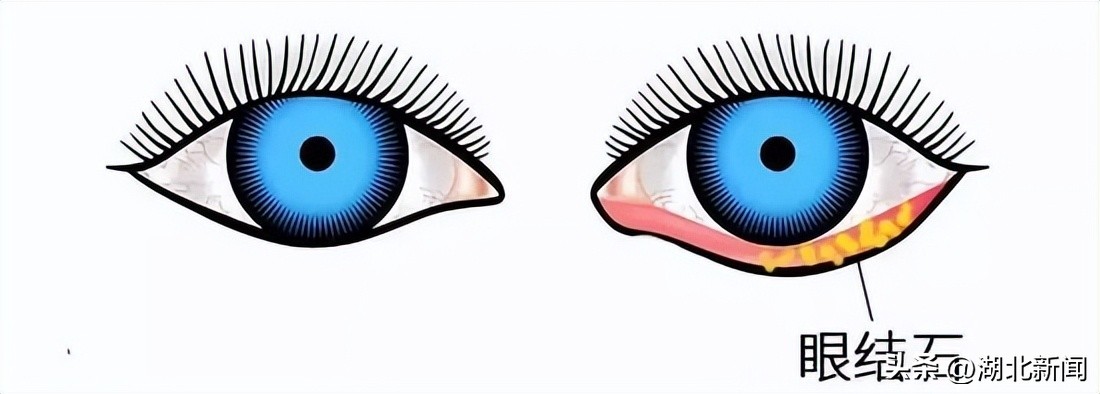 眼睛经常戴隐形眼镜,眼睛也要长结石吗