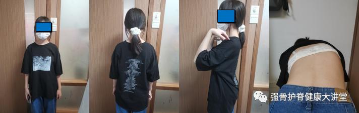 生长发育引起的脊柱侧弯,医学讲解脊柱侧弯怎样引起