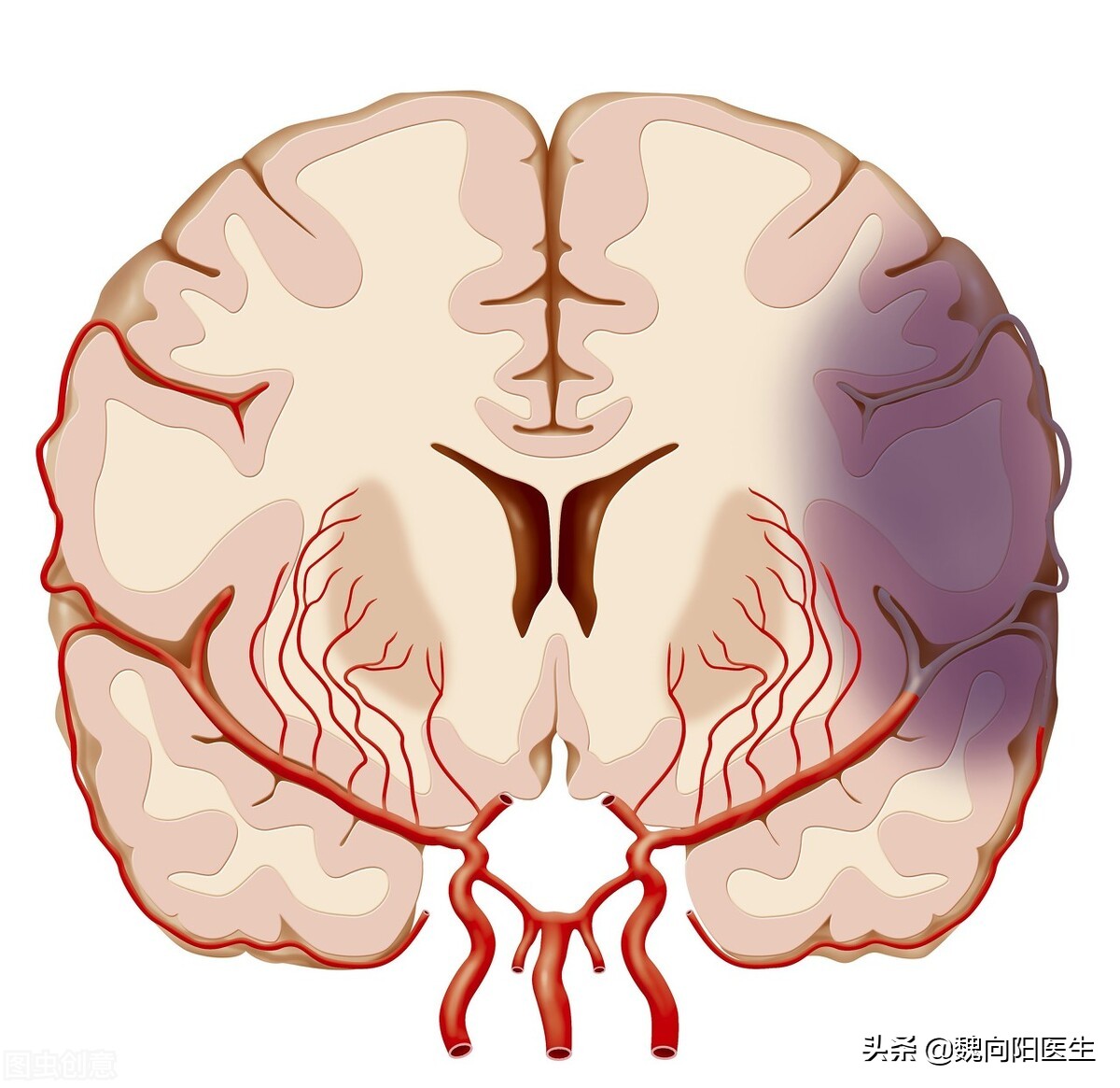 脑动脉狭窄需要血管搭桥吗,脑动脉狭窄不吃药行吗