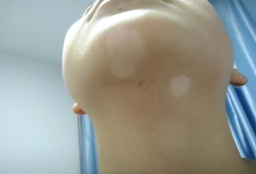 咨询：外阴白斑是白癜风吗？对身体会有哪些危害？