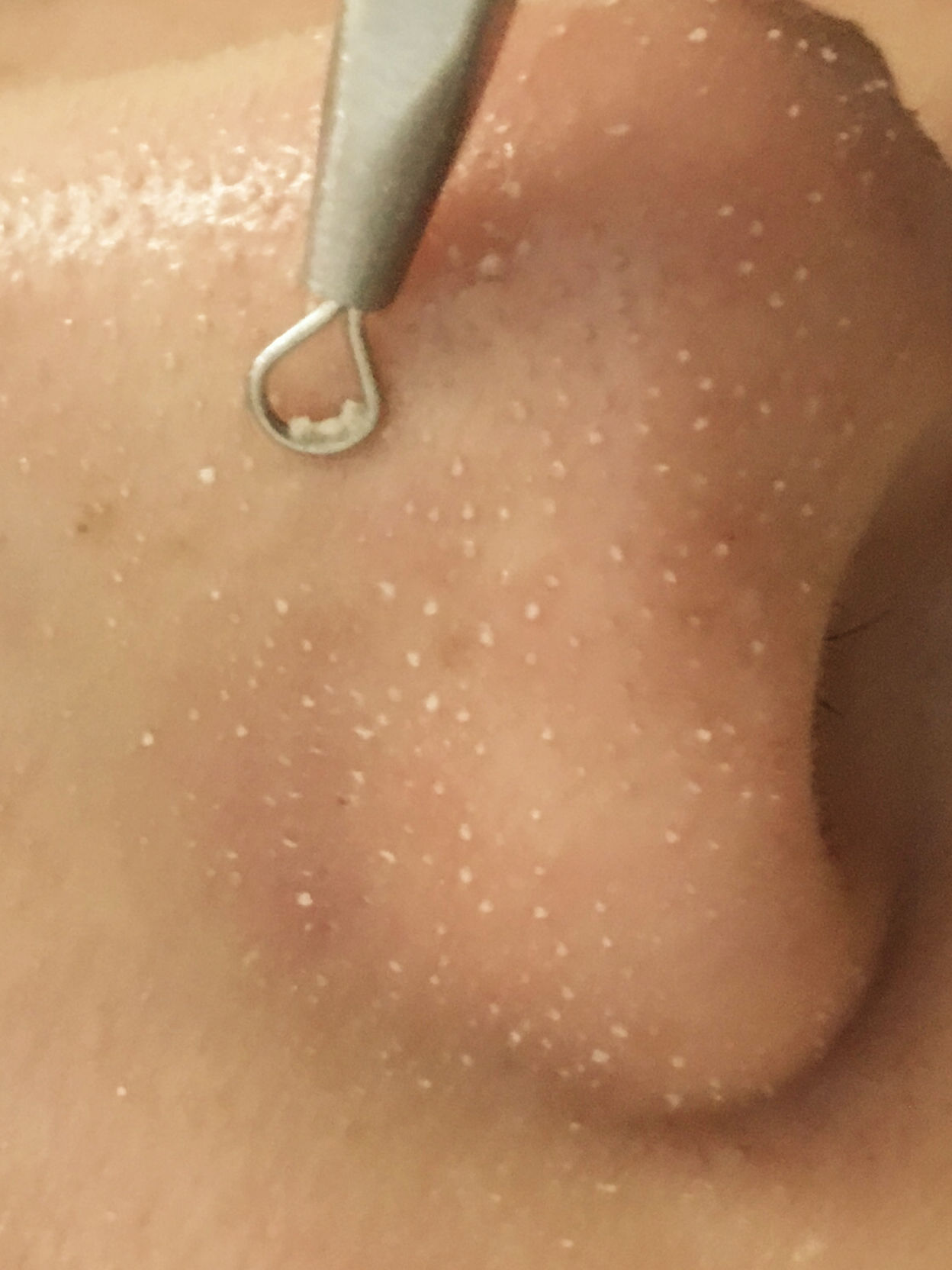 鼻子上挤出油脂粒毛孔怎么收缩,鼻子毛孔的油脂粒怎么去除