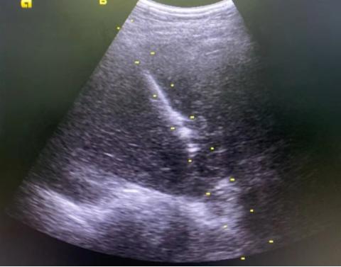 介入穿刺全过程,介入穿刺技术
