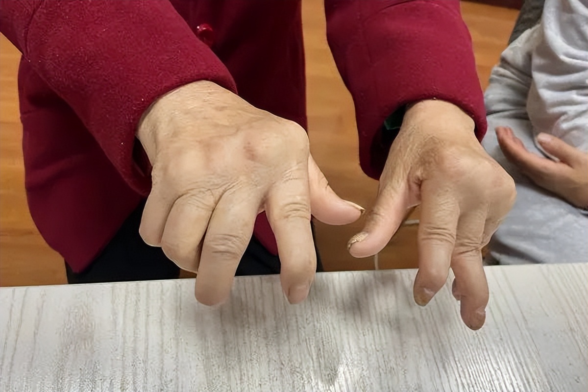 类风湿如何能治好可以泡脚吗,艾灸治好了类风湿