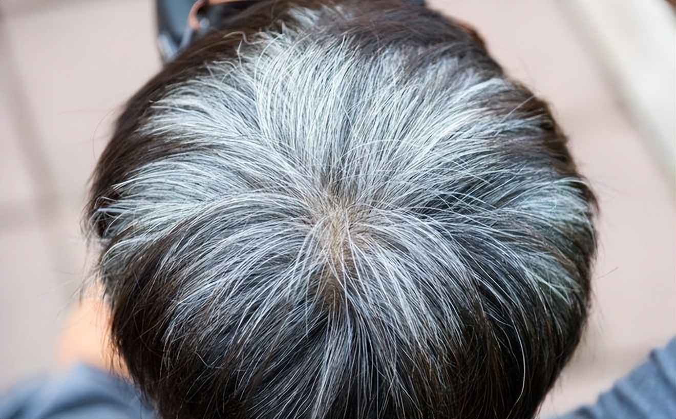 身体缺乏哪种维生素会导致白发,人体缺少什么营养素会造成白发