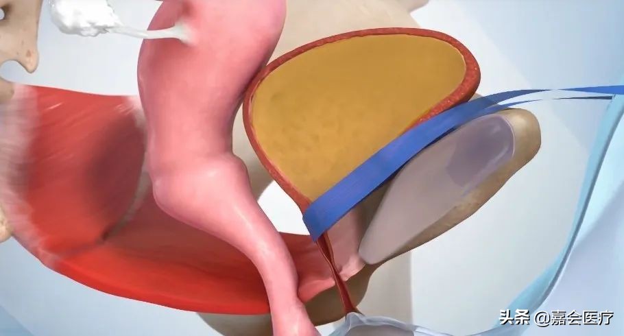 「女性压力性尿*禁失**」拒绝向膀胱妥协，为了更好的生活