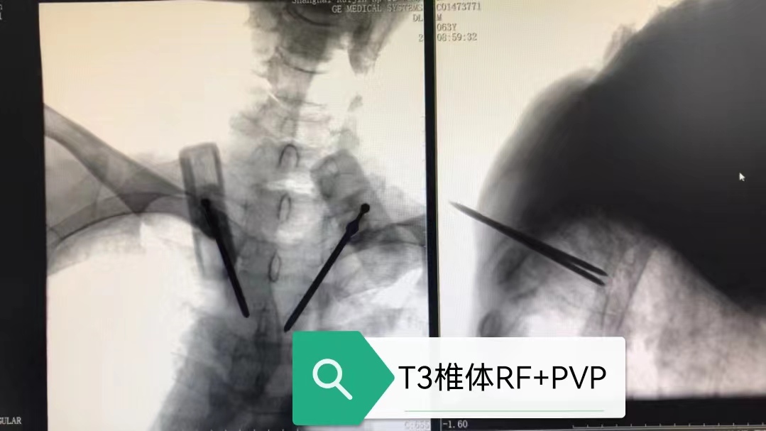 病例Ⅴ：RF+PVP联合治疗高位胸椎溶骨性转移瘤及压缩骨折