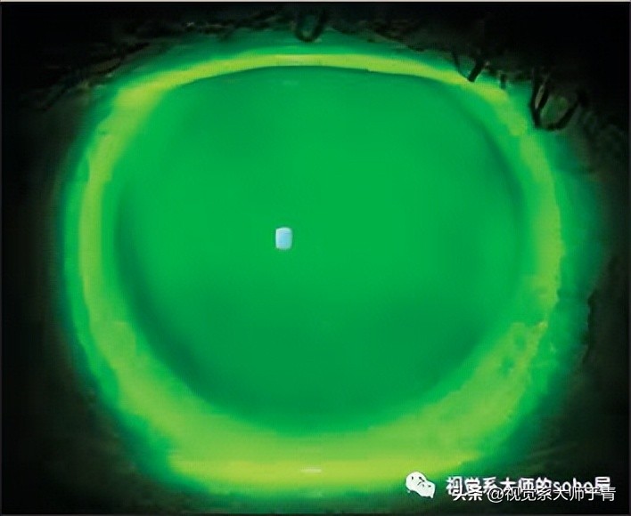 巩膜镜的验配技巧及案例分享,试戴巩膜镜成功率高不高