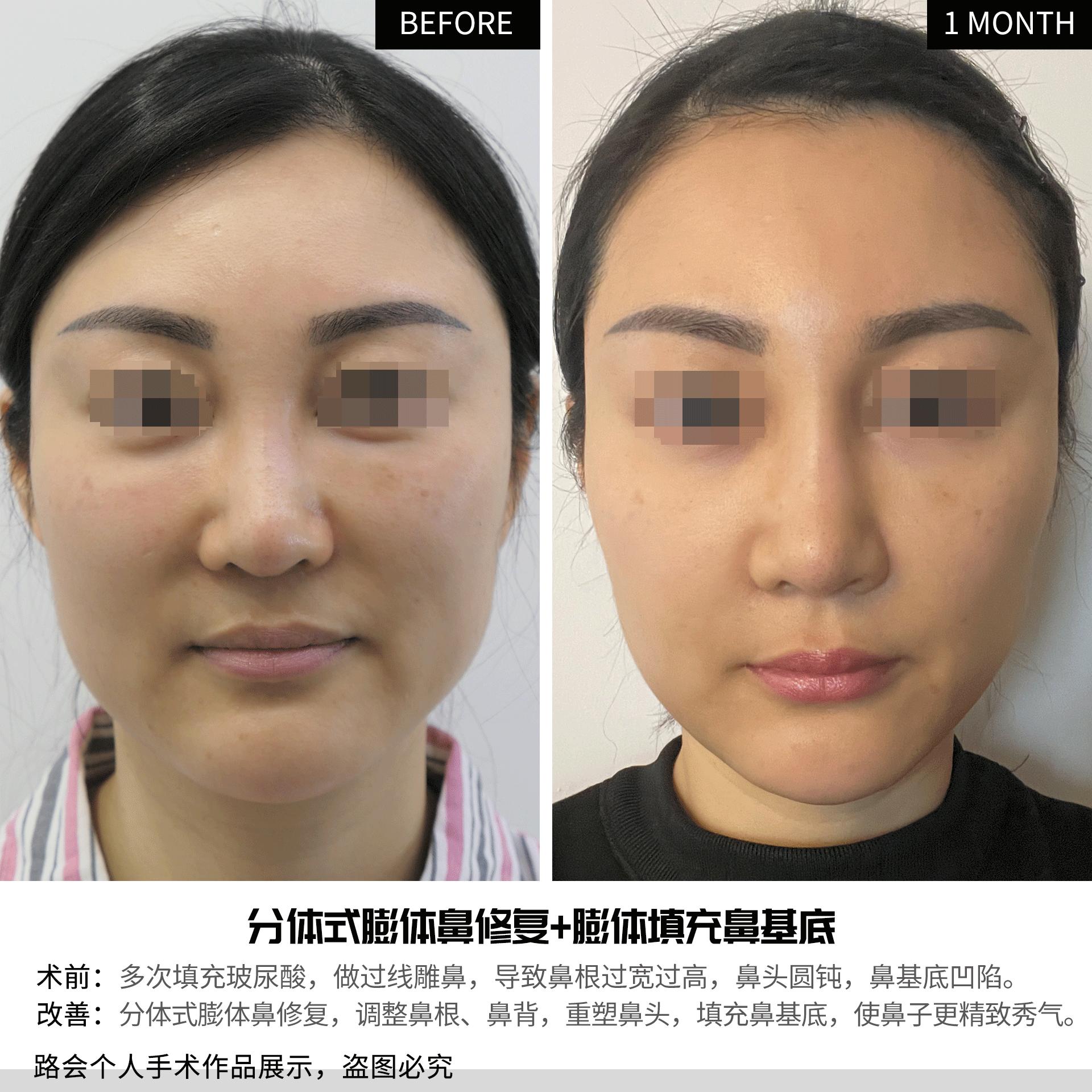 玻尿酸隆鼻立竿见影吗,玻尿酸隆鼻适合哪些鼻型