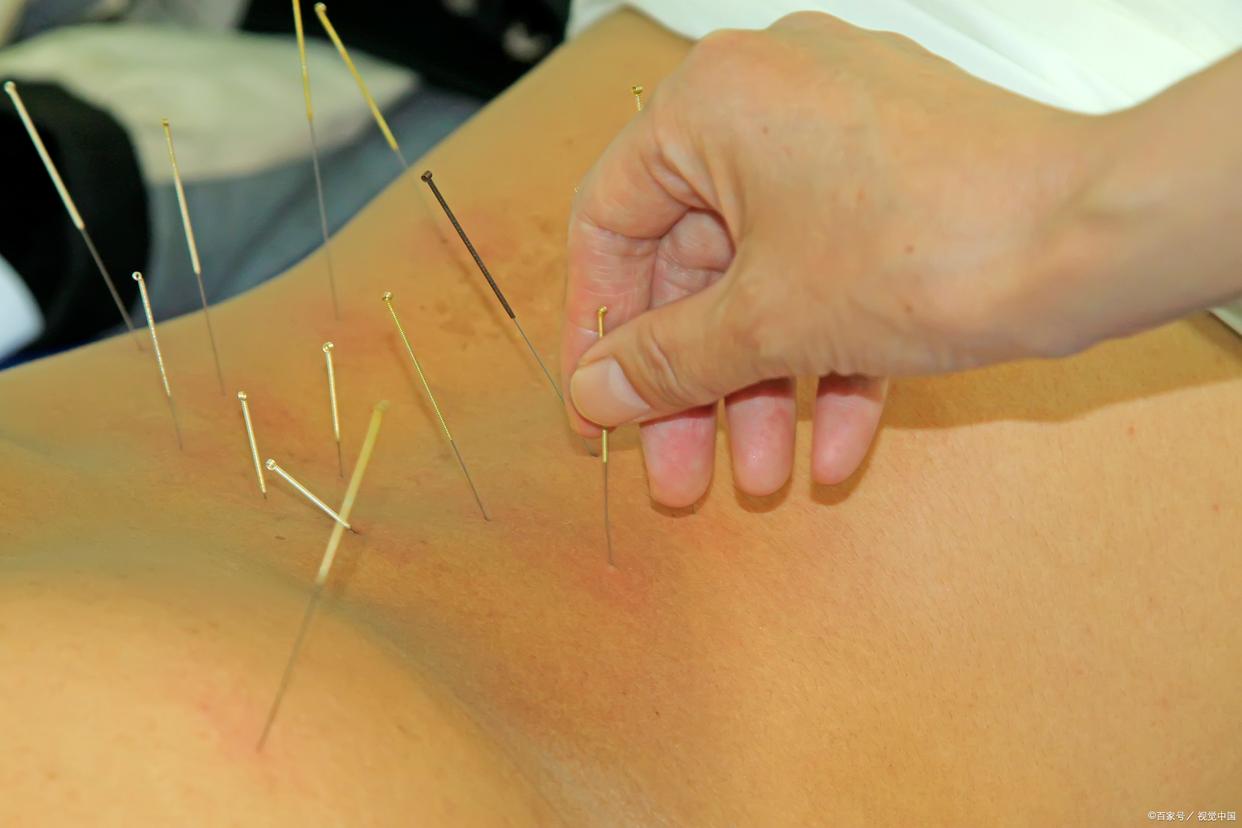针灸扎破血管怎么恢复,针灸扎破血管怎么办