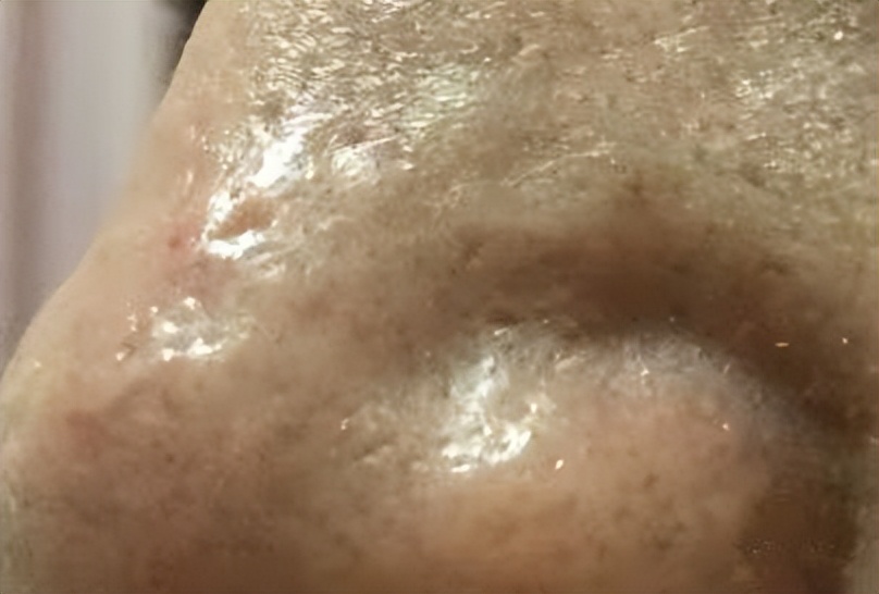 眉心鼻翼和下巴长粉刺为什么,鼻头上起粉刺什么原因引起的图片