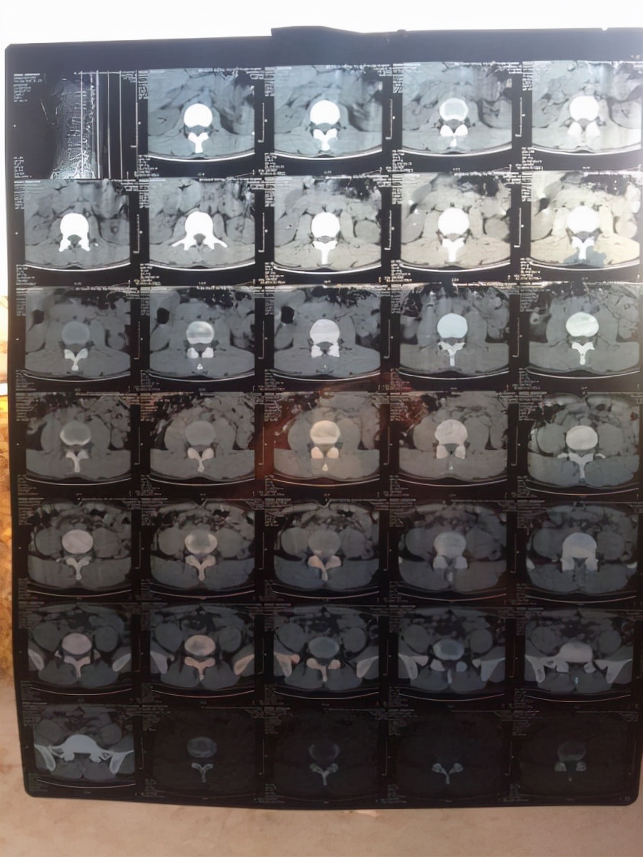 老年人骨质疏松引起疼痛原理,老年人骨质疏松骨痛最佳治疗方法