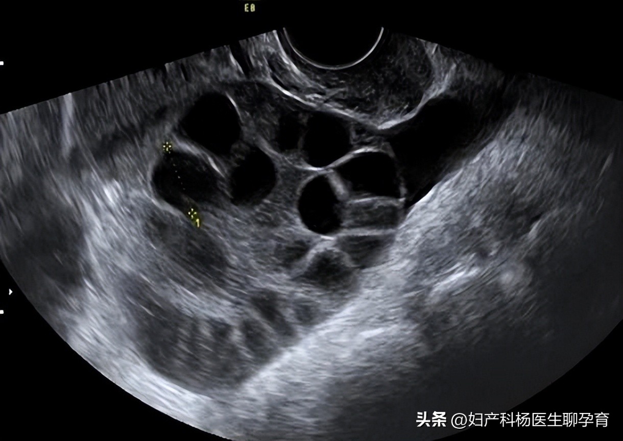 有卵巢囊肿又有多囊卵巢综合征,卵巢囊肿超声检查一般显示什么