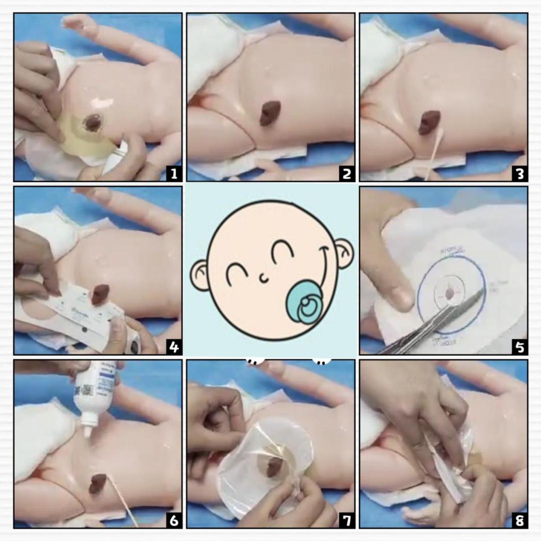 【收藏】肠造口术后护理，家有肠造口宝宝速来领取