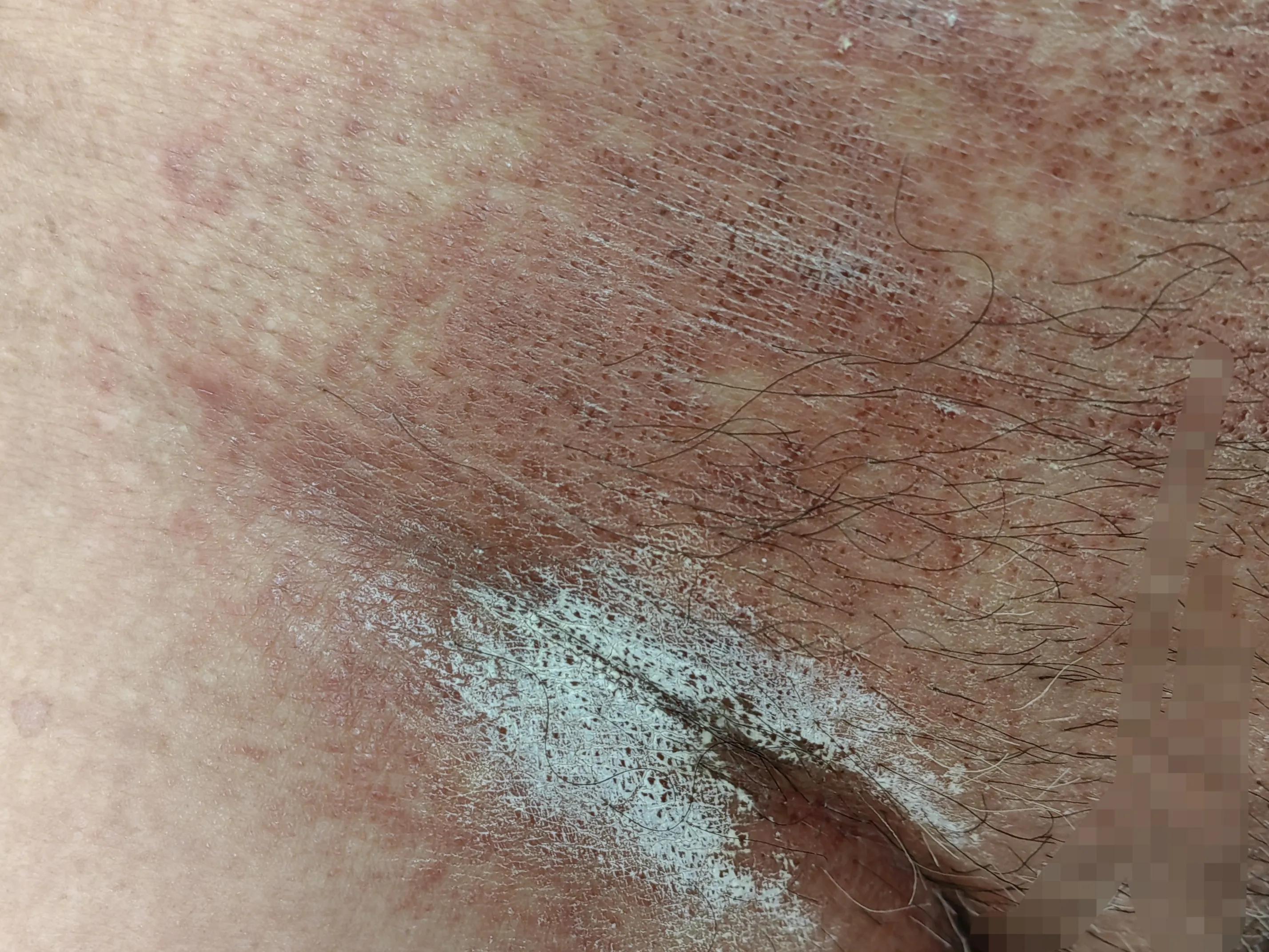 对镍过敏是怎么回事,镍过敏的人多不多