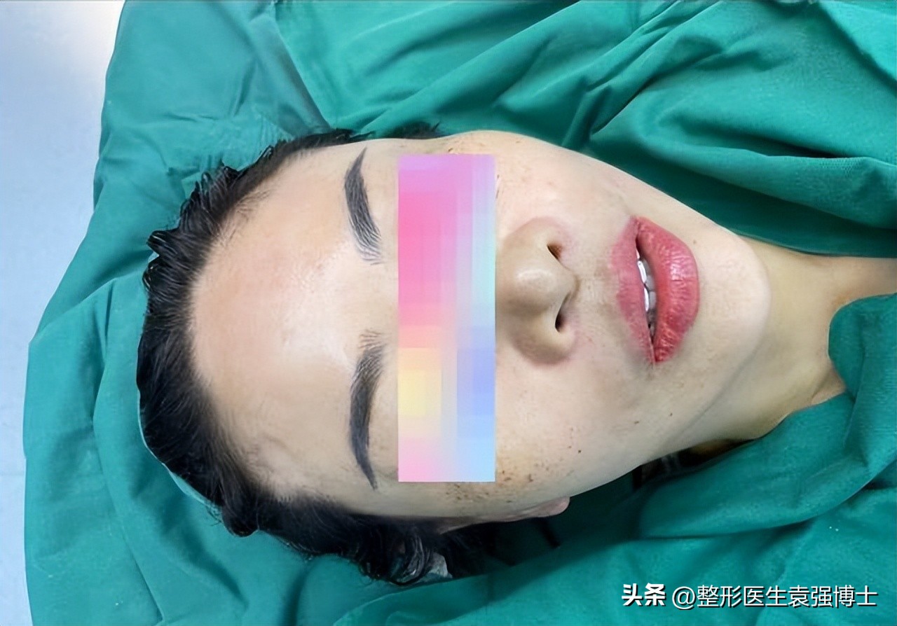 做拉皮手术会越来越薄吗,拉皮手术危险有真相