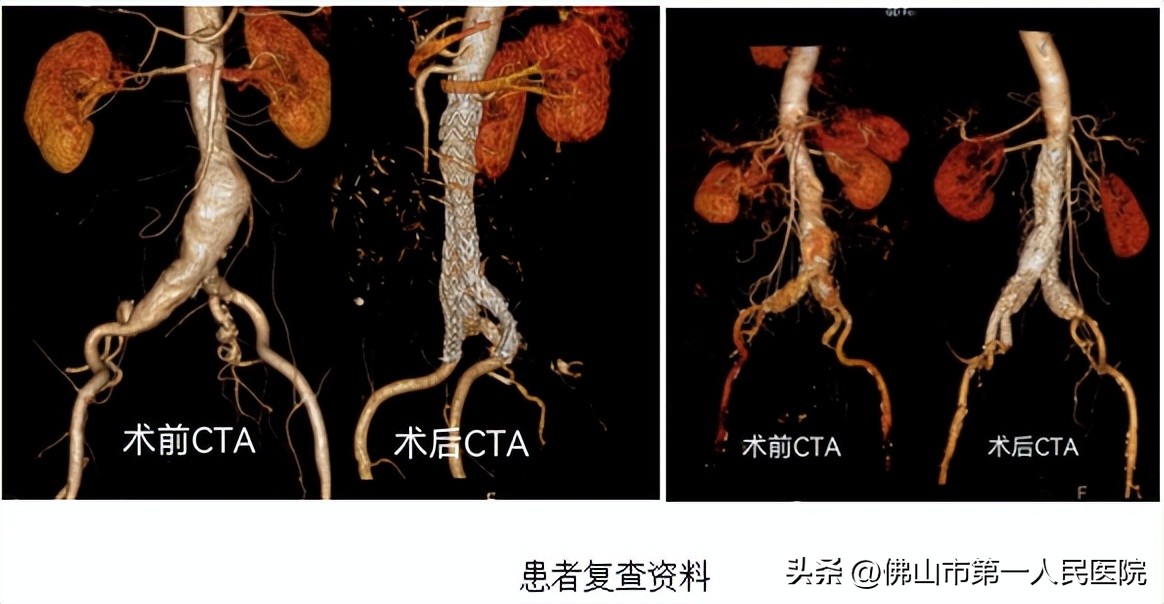新技术！佛山首例重建髂内动脉术让腹主动脉瘤治疗不用“弃车保帅”了