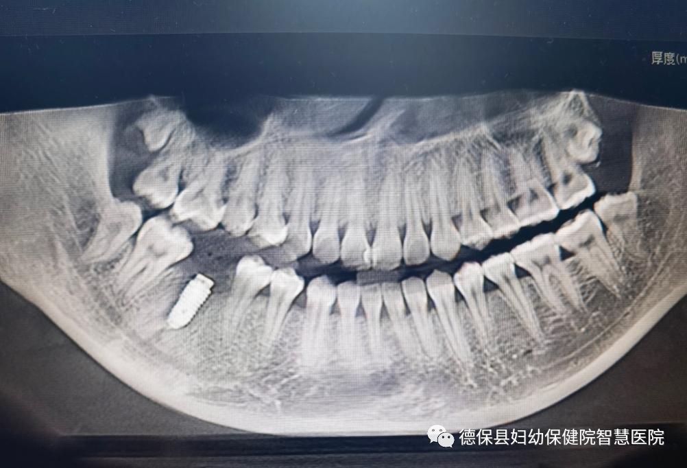 德保县妇幼保健院建设项目,德保人民医院牙科可种牙吗