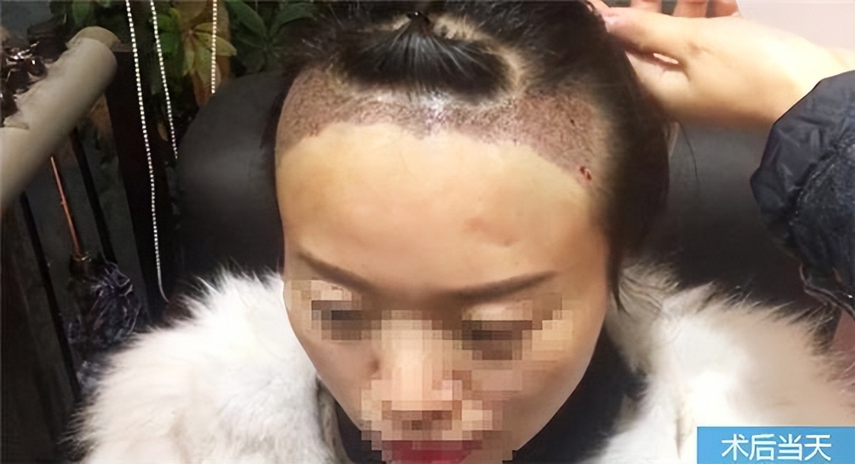植发真的有用吗现在很多植发医院,效果最好的植发方法
