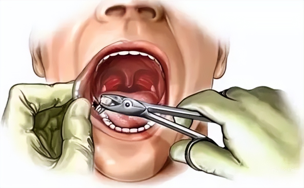 拔牙引起头疼痛怎么办,拔牙疼痛属于几级疼痛