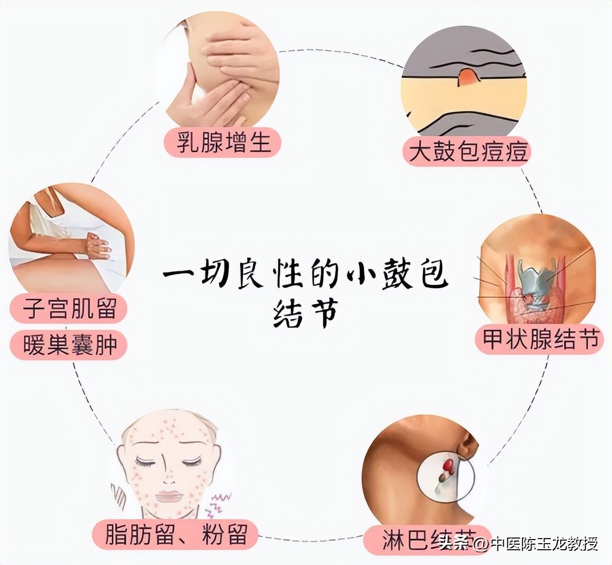 逍遥丸搭配什么对结节和肌瘤好,逍遥丸和什么搭配能软坚散结