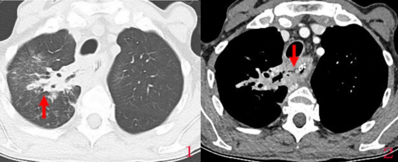 食管瘘介入治疗方法,食管瘘气管瘘的治疗成功率有多大