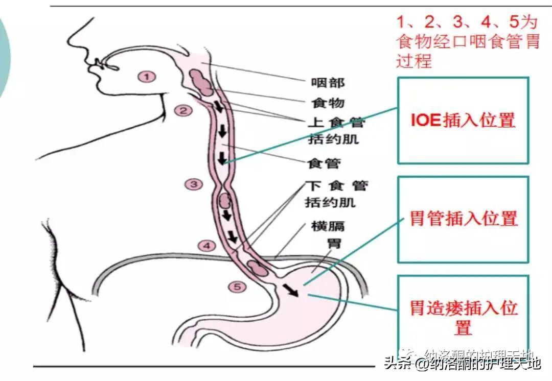 病人不肯插胃管怎么办,病人无法吞咽如何喂水