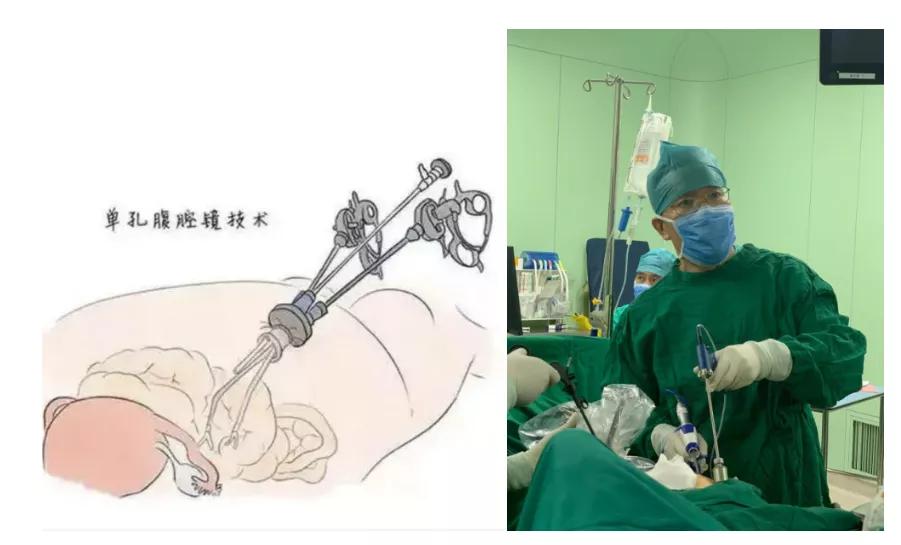 微创妇科手术是什么样的手术,妇科微创手术和传统手术的区别