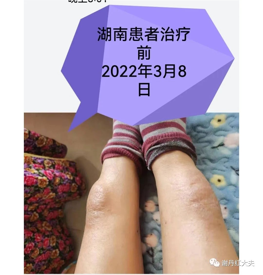 胫前黏液性水肿见于哪些病,胫前黏液性水肿为凹陷性水肿吗