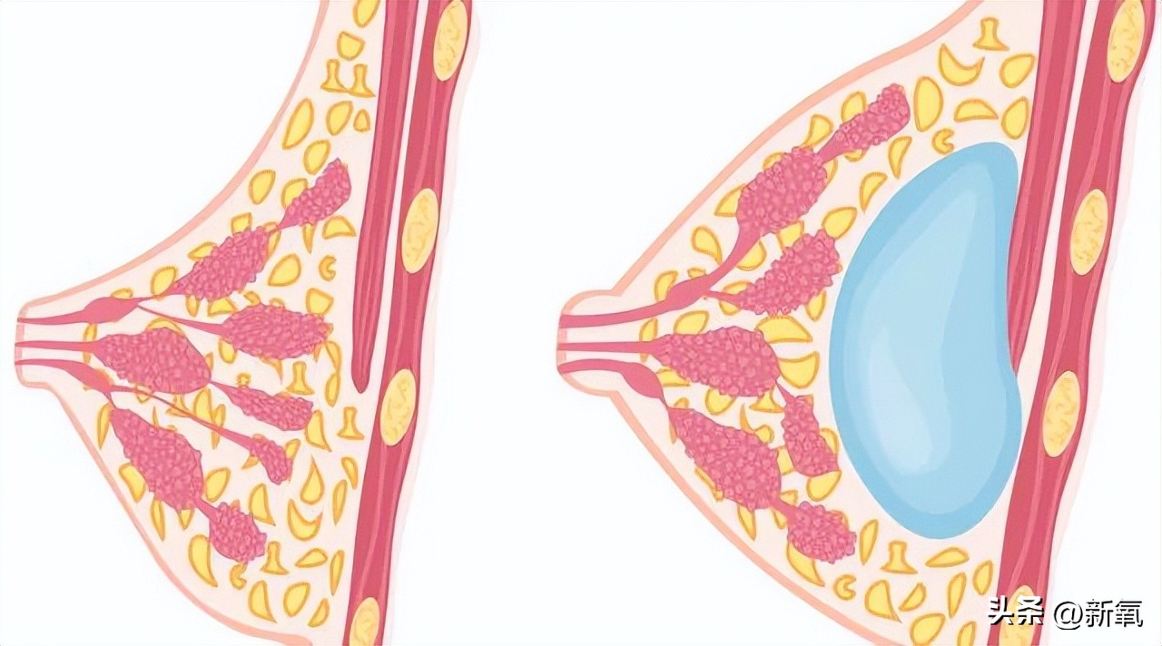 胸部略微下垂,胸部有时变大有时变小怎么回事