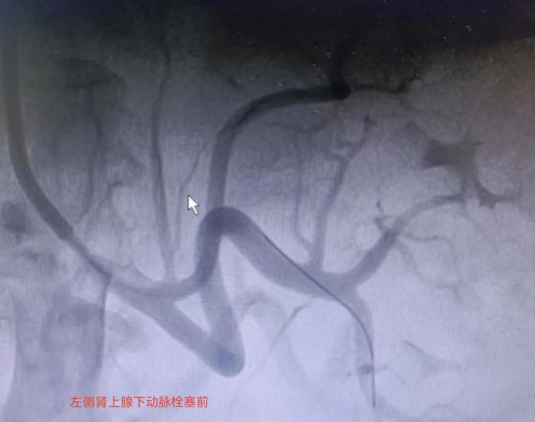 高血压三级能否调理正常,三台县中医院治疗高血压吗