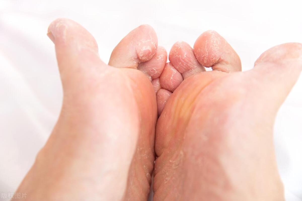 把有脚气的袜子和衣服一起洗,袜子内裤一起洗一次就感染霉菌了