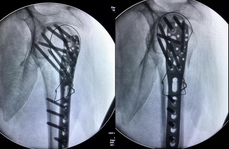 肱骨近端骨折属于几级伤残,肱骨近端骨折康复训练技巧